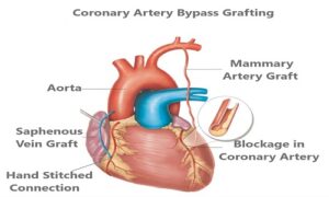 Coronary Artery Bypass