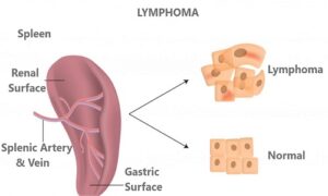 Lymphoma Treatment