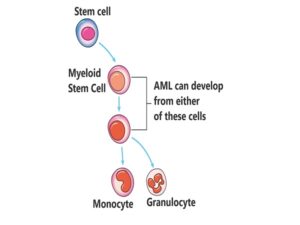 Acute Myeloid Leukemia