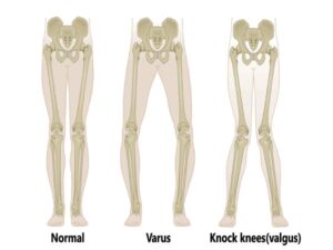 Ankle Valgus Deformity | Orthopaedic Surgeon Hospital Treatment Cost