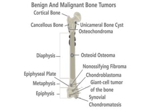 Benign And Malignant Bone Tumors