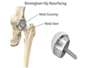 Birmingham Hip Resurfacing