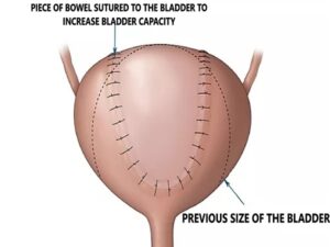 Bladder Augmentation Surgery