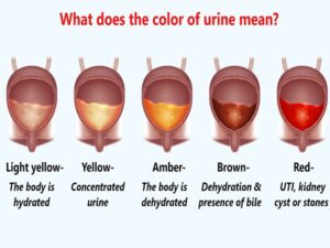 Blood in the Urine