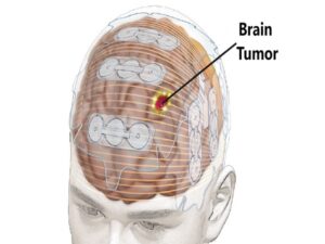 Brain Cancer