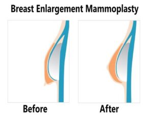 Breast Enlargement Mammoplast