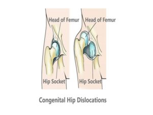 Congenital Hip Dislocations