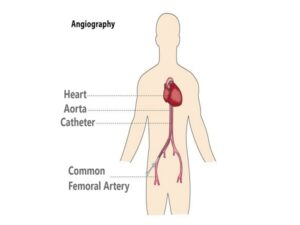 Coronary Angiogram