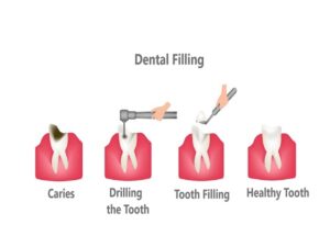 Dental Filling in india