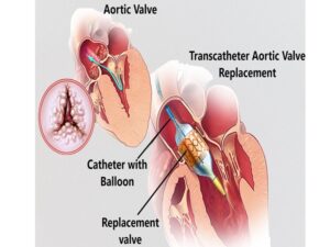 Aortic valve replacement