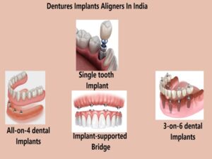 Dentures Implants Aligners