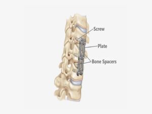 ACDF Surgery Cost in India