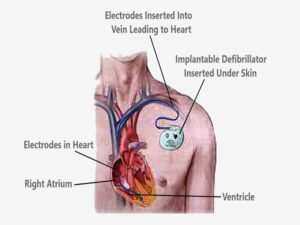 AICD Implantation in India