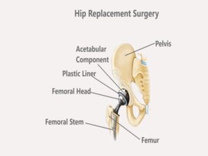 Hip Replacement Surgery In India