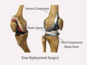 Knee Replacement Surgery