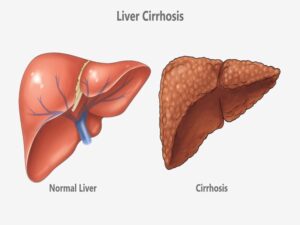 Liver Cirrhosis Treatment in India