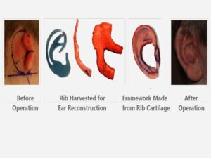 Microtia Surgery cost in india