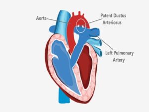 Patent Ductus Arteriosus (PDA) in India