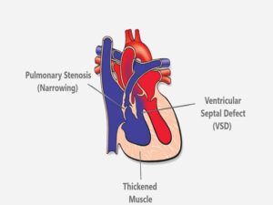 Tetralogy of Fallot