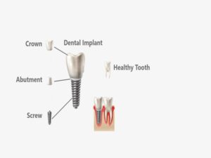 Types of Dental Implants