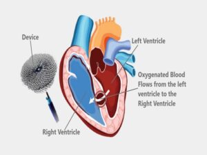 VSD Closure Surgery in India