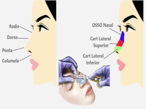 Rhinoplasty Cost in India
