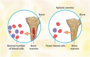 Aplastic Anemia in Children