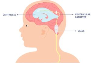 VP Shunt Surgery Cost in India